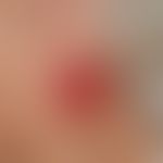 Squamous cell carcinoma of the skin: large, painless, flat ulcerated lump, still movable above th...
