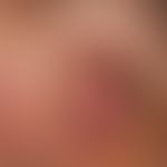 Squamous cell carcinoma of the skin: large fleshy lump that is not painful but only disturbs slee...