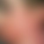 Keloid:&nbsp;großflächige Keloidbildung nach Verbrennung im Gesicht.
