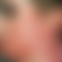 Keloid. Large-area keloid formation after facial burns.
