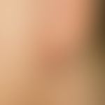 Keloid. Umschriebener, das Hautniveau deutlich überragender Knoten am Ohrläppchen nach Stechen vo...