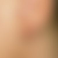 Keloid: circumscribed lump on the earlobe which clearly protrudes above the skin level after pier...