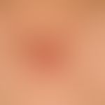 Keloid. In der Breite bis 6,5 cm, in der Höhe bis 3,5 cm großes Narbenkeloid bei einem 55-jährige...