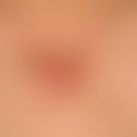 Keloid. In der Breite bis 6,5 cm, in der Höhe bis 3,5 cm großes Narbenkeloid bei einem 55-jährige...