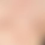 Keloid: diskontinuierliche, wulstige, prominente, livid-rote, nicht über den Narbenbereich hinaus...