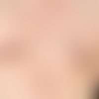 Keloid: diskontinuierliche, wulstige, prominente, livid-rote, nicht über den Narbenbereich hinaus...