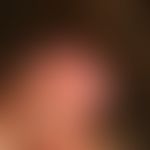 Keloid: chronisch dynamischer, in den letzten 6 Monaten stark zunehmender, an der linken Ohrhelix...