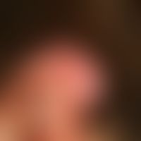 Chronically dynamic, in the last 6 months strongly increasing, at the left ear helix localized, p...
