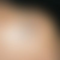 Keloid. chronically stationary clinical picture. multiple, linear, skin-coloured smooth plaques t...