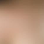 Keloid:&nbsp;chronisch stationäres, aknetypisch verteiltes Krankheitsbild. Multiple, im Bereich d...
