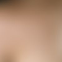Keloid. chronically stationary, acne-typically distributed clinical picture. multiple, in the are...