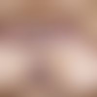 keloid. large, brown to brown-red, very rough, smooth nodes with a jagged edge structure. not pai...