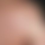 Keloid. 20 Jahre alter Patient. Seit der Pubertät bekannte Acne vulgaris. Wochen bis Monate nach ...