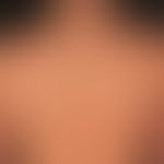 Zahlreiche Keloide und hypertrophe Narben, nach inzwischen weitgehend abgeheilter Acne vulgaris.
