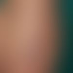 Keloid: ungewöhnlich großes Keloid, das nach einer Fleischwunde aufgetreten ist. Ansonsten sind b...