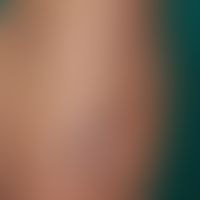 Unusually large keloid that appeared after a flesh wound, otherwise banal wounds healed keloid-fr...