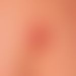 Keloid: wenige Monate&nbsp;altes, noch wachsendes&nbsp;Keloid nach einer banalen Verletzung entst...