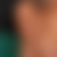 Keloid: 22 Jahre alte Äthiopierin bei der auf Grud von Stammesritualen Verletzungen der unteren&n...