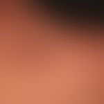 Keloide:&nbsp;Offenbar spontan entstandene Keloide (Spontakeloide). Kein Trauma erinnerlich. Kein...