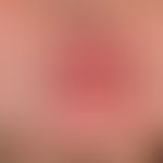 Keloid:&nbsp;entstanden nach einem kosmetischen Eingriff zur Straffung der Gesichtshaut.
