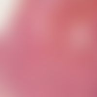 Keratoakanthom. Ausgereiftes Keratoakanthom mit breiten, in den oberen Anteilen ausgereiften, epi...