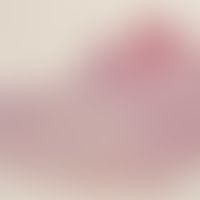 Keratoakanthom. Überwiegend exophytisch wachsender Tumor mit invaginiertem, zentralem Honkrater. ...