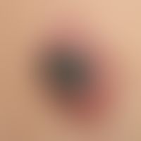 Keratoakanthom: seit wenigen Monaten bestehender, initial planer, in den letzten 2 Monaten stark ...