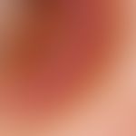 Keratoakanthom. Auflichtmikroskopie: Detailaufnahme einer Läsion vom Oberschenkel einer 65-jährig...