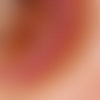 Keratoakanthom. Auflichtmikroskopie: Detailaufnahme einer Läsion vom Oberschenkel einer 65-jährig...