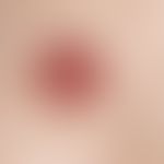 Keratoakanthom. Schnell wachsender roter Knoten auf normaler Haut mit wallförmig aufgeworfenem Ra...