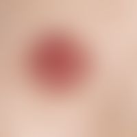 Keratoacanthoma: Rapidly growing red lump on normal skin with a wall-like raised edge enclosing a...