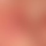 Keratoakanthom.&nbsp;Typischer klinischer Aspekt mit peripherem Randwall und zentralem Hornpfropf.
