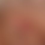 Keratoakanthom: seltene Lokalisation eines ansonsten vom Verlauf (6 Wochen bestehend) und klinisc...