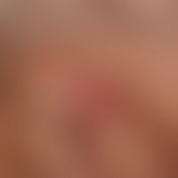 Keratoakanthom: seltene Lokalisation eines ansonsten vom Verlauf (6 Wochen bestehend) und klinisc...