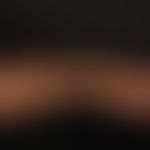 Keratoakanthom, Riesenkeratoakanthom: Seitenansicht des beschriebenen Riesenkeratoanthoms.
