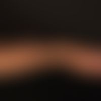 Keratoakanthom, Riesenkeratoakanthom: Seitenansicht des beschriebenen Riesenkeratoanthoms.
