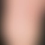 Keratoma sulcatum: Disseminated, as if punched out, smallest corneal layer defects; distinct hype...