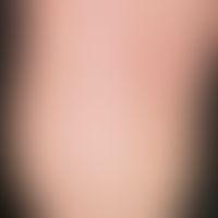 Keratoma sulcatum: disseminierte, wie ausgestanzt wirkende, kleinste Hornschichtdefekte; deutlich...