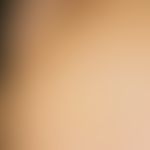 Keratoma sulcatum, extensive corneal layer defects in hyperhidrosis plantaris, and isolated small...