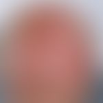 Keratosis actinica:&nbsp;Nebeneinander von erythematösen und verhornten Arealen im Bereich des ha...