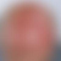 Keratosis actinica:&nbsp;Nebeneinander von erythematösen und verhornten Arealen im Bereich des ha...