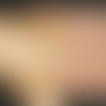Keratosis actinica erythematöser Typ: Chronischer Lichtschaden der Handrücken mit multiplen&nbsp;...