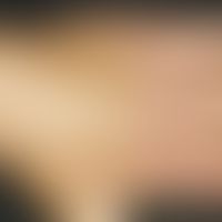 Keratosis actinica erythematöser Typ: Chronischer Lichtschaden der Handrücken mit multiplen&nbsp;...
