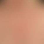 Keratosis actinica lichenoider Typ. Seit Jahren progrediente, z.T. kleinflächige, rote, gering sc...