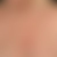 Keratosis actinica lichenoider Typ. Seit Jahren progrediente, z.T. kleinflächige, rote, gering sc...