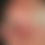 Keratosis actinica. Übersichtsaufnahme: Seit 8 Jahren persistierende, gering größenprogrediente, ...