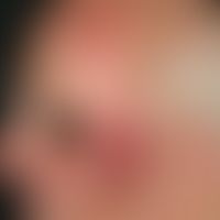 Keratosis actinica. Übersichtsaufnahme: Seit 8 Jahren persistierende, gering größenprogrediente, ...
