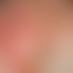 Keratosis actinica:&nbsp;4.5 x 3 cm messende, nicht scharf begrenzte, erythematöse, leicht infilt...