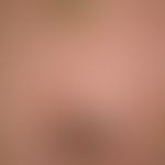 Keratosis actinica Cornu cutaneum Typ:&nbsp; Umschriebene&nbsp; Hyperkeratosen mit derber, massiv...
