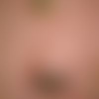 Keratosis actinica Cornu cutaneum Typ:&nbsp; Umschriebene&nbsp; Hyperkeratosen mit derber, massiv...